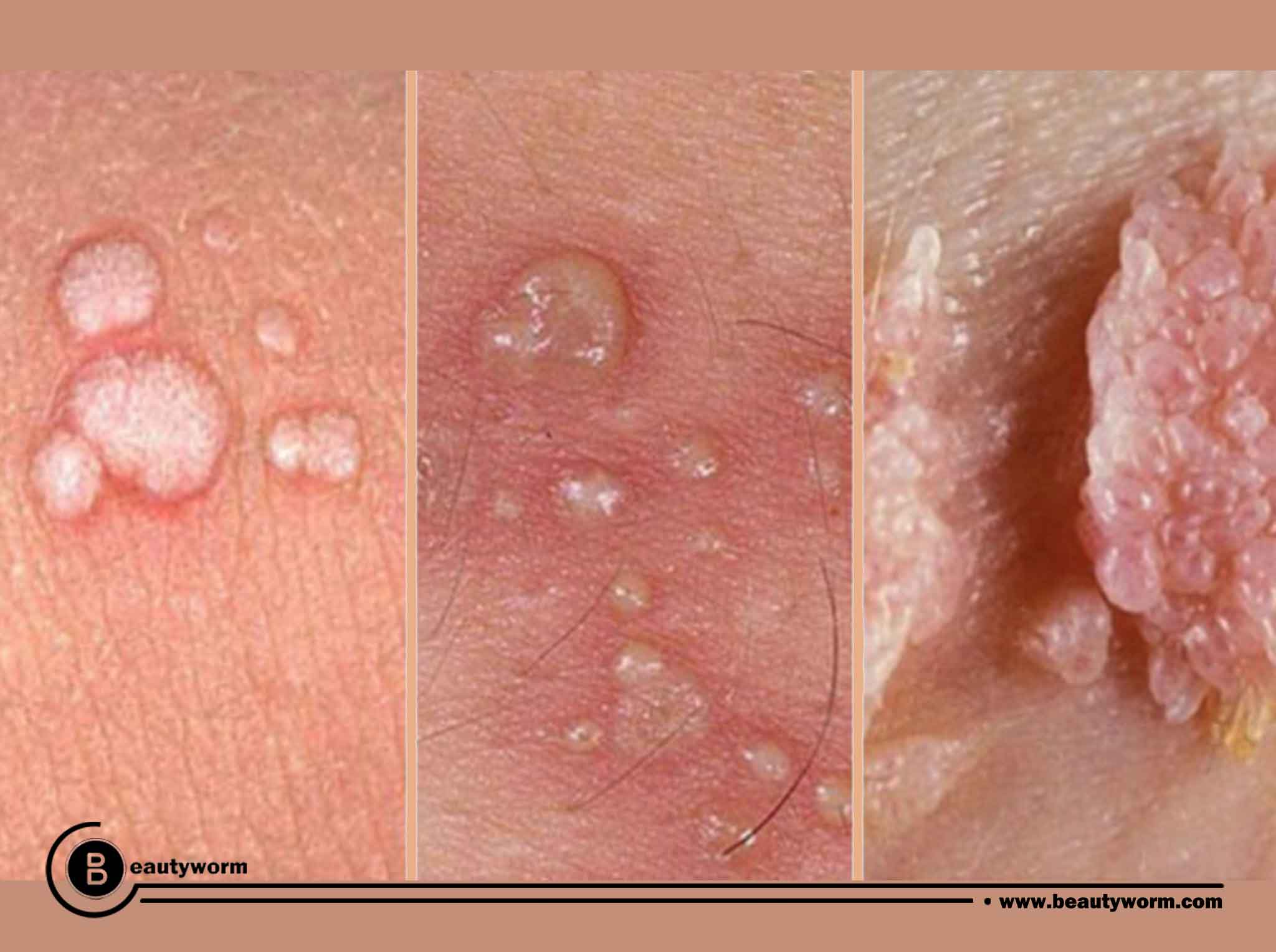 What are the symptoms of HPV?(The warts)